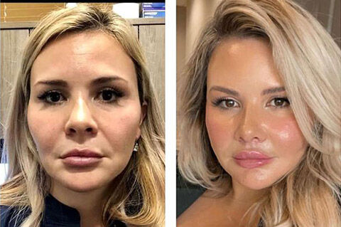 What is a Mini Facelift and Who Should Consider It?